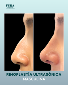 Rinoplastia