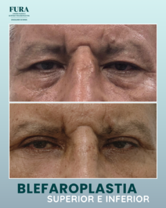 Blefaroplastia