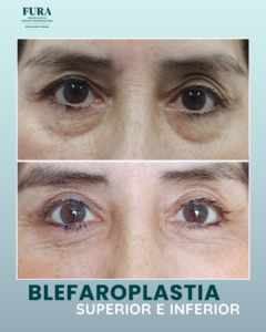 Blefaroplastia