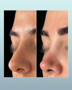 Rinoplastia